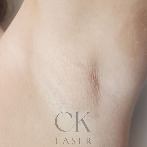 CK Laser Hair Removal after picture