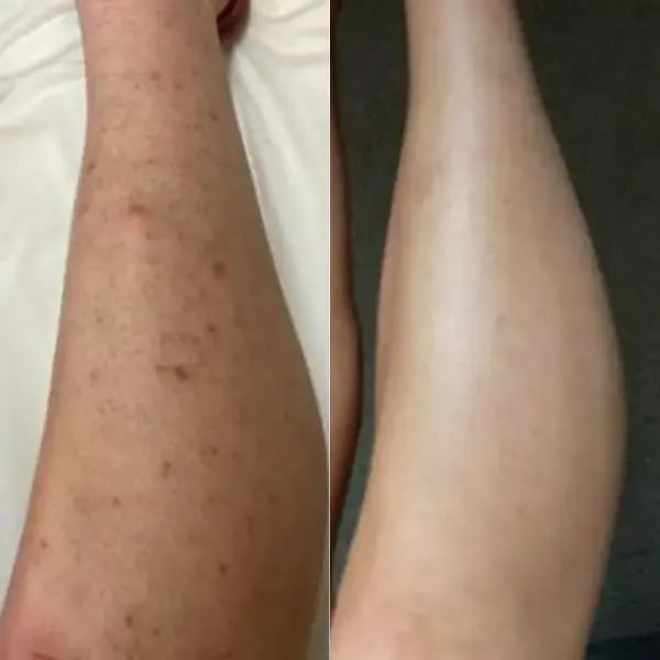Laser hair removal before and after
